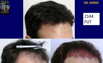 Before and after hair transplantation result photographs