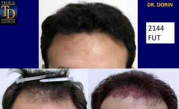 Surgical hair transplantation result photographs