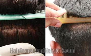 Residual scar of hair transplant recipient images