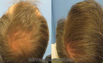 Back / Crown view before and after hair transplant