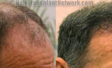 Right view before and after hair transplant procedure