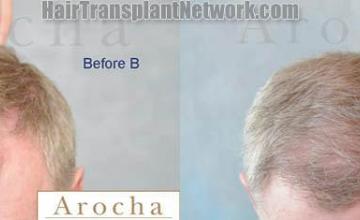 Hair restoration procedure before and after images