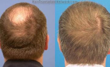 Back view before and after hair transplant procedure