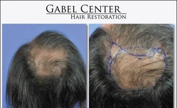 Hair transplantation surgery before and after pictures