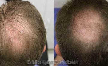 Hair transplantation surgery before and after images