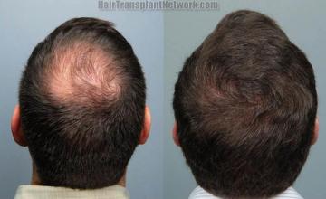 Surgical hair transplantation result photographs