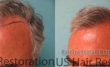 Hair transplantation surgery before and after images