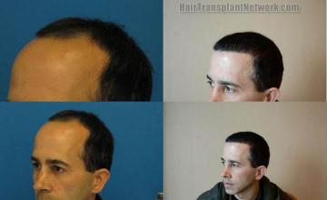 Hair restoration procedure before and after pictures