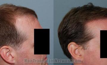 Right view before and after hair transplantation surgery