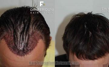 Top view - Before and after hair transplantation surgery