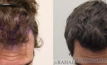 Top view before and after hair restoration results