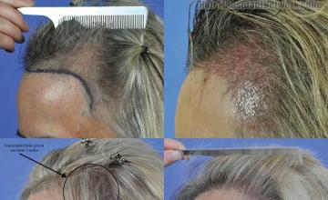 Left view before and after hair restoration procedure