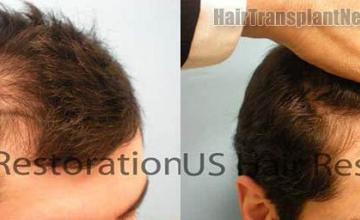 Hair replacement surgery result images before and after