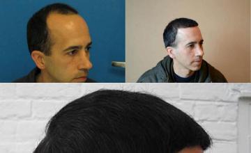 Hair transplantation surgery before and after pictures