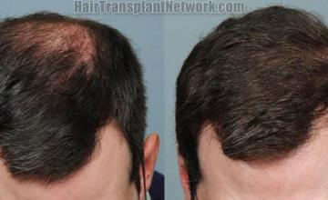 Top view - Before and after surgical hair replacement