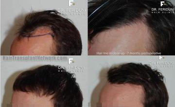 Left view before and after hair restoration procedure