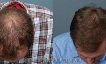 Top view before and after photos from hair transplant