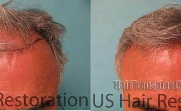 Top view before and after hair restoration results