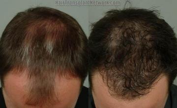 Top view before and after hair restoration results