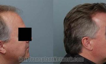 Right view before and after hair transplantation images