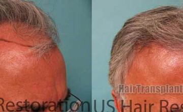 Before and after hair transplant procedure images