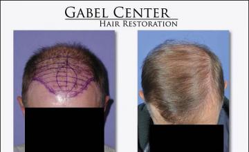 Top view - Before and after surgical hair replacement