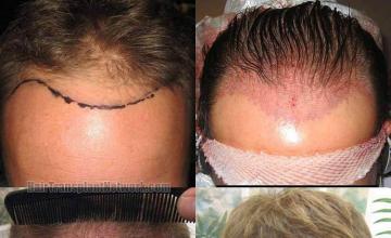 Before and after hair transplant procedure images