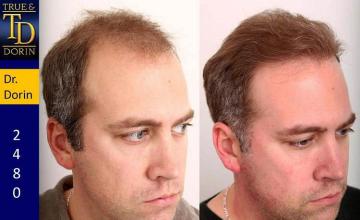 Hair restoration procedure before and after results