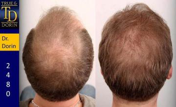 Hair transplantation surgery before and after photos