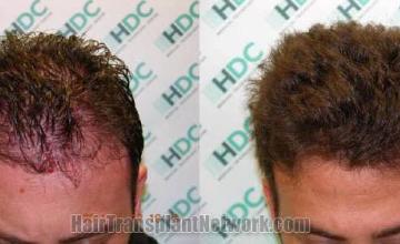 Top view before and after hair restoration results