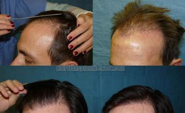 Left view before and after hair transplantation images