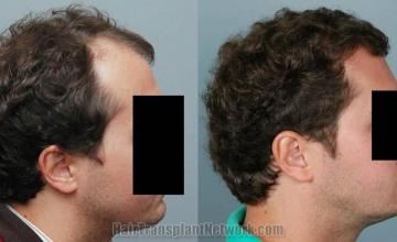 Hair transplantation surgery before and after photos