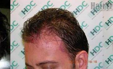 Hair transplantation surgery before and after photos