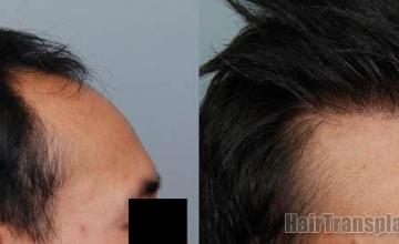 Hair restoration procedure before and after results