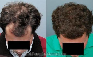 Top view - Before and after surgical hair replacement