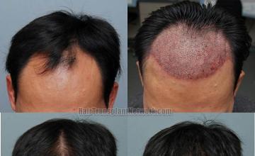 Before and after hair transplant procedure images