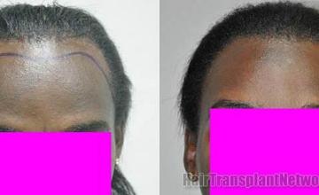 Before and after  - African female