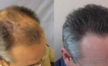 Hair restoration procedure before and after results