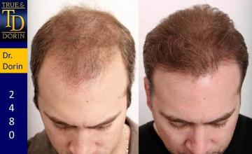 Before and after hair transplantation result photographs