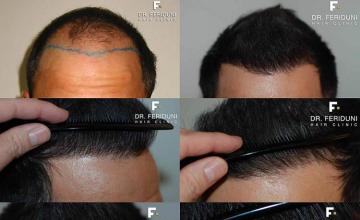 Hair restoration procedure results