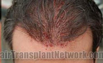 immediate postoperative images from hair transplantation