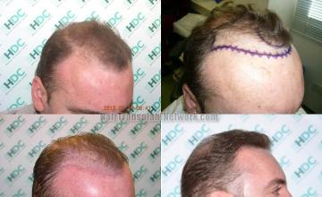 air transplantation surgery before and after pictures