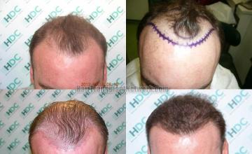 Hair restoration procedure before and after results