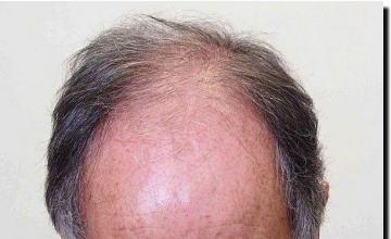 Hair restoration procedure results