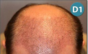 Hair restoration procedure results