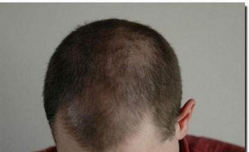 Hair restoration procedure results