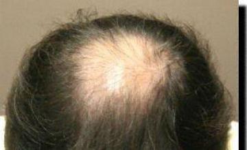 Hair restoration procedure results