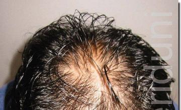 Hair restoration procedure results