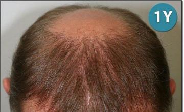 Hair restoration procedure results