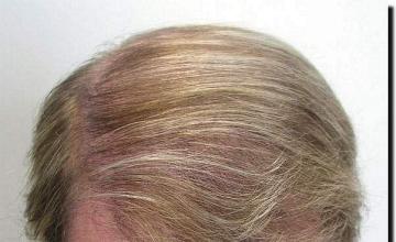 Hair restoration procedure results